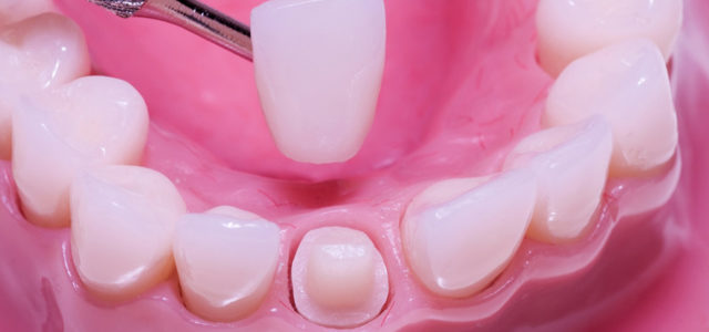 Kako da krunice na zubima traju duže